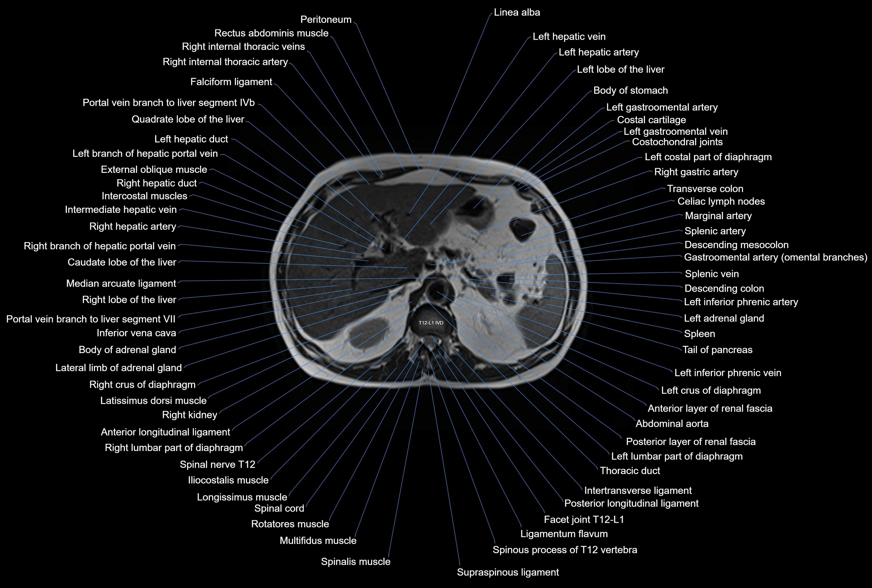 MRI Abdomen axial cross sectional anatomy radiology  image-img-00001-00014.webp